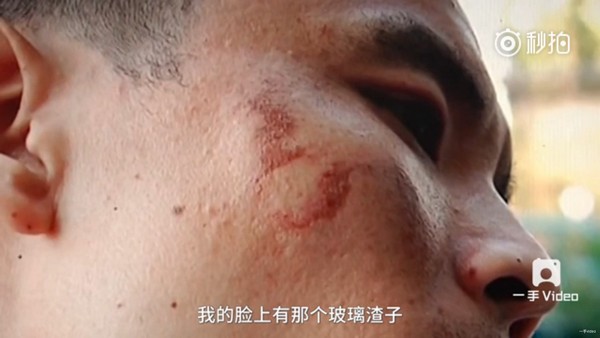 別笑 Samsung：蘋果 iPhone 7 傳出爆裂案例；用戶臉頰被刮傷但蘋果一週後仍沒回應！ 2