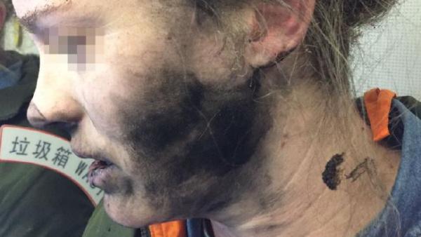 懷疑鋰電池過熱！耳機於飛機上突然爆炸澳洲女子險毀容