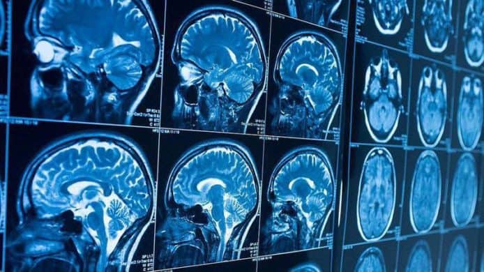 人工智能診斷腦瘤準確度達 87％　擊敗人類頂尖醫生