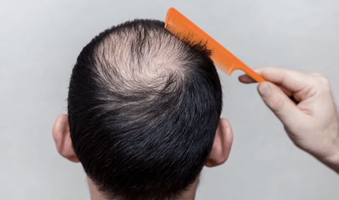研究報告：造成圓禿的基因　或可提升癌症免疫療效