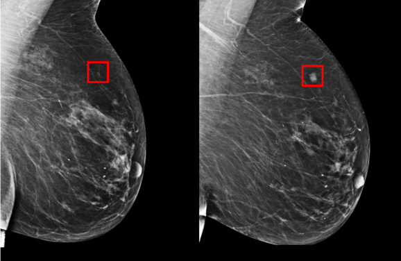 MIT 人工智能系統助女性提早五年識別乳癌徵狀