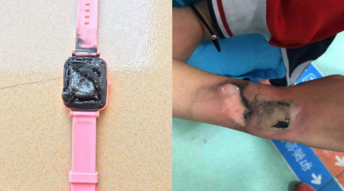 中國智能手錶冒煙自燃　小學生遭高溫燙傷手腕