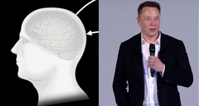 Elon Musk 腦機技術開始人體試驗　植入晶片幫助腦與脊椎傷者