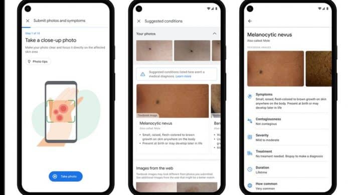 Google 開發 AI 工具提供醫療建議　針對皮膚問題而設
