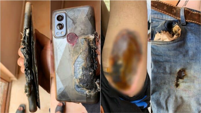 OnePlus Nord 2 再發生爆炸   印度用戶大腿嚴重燒傷