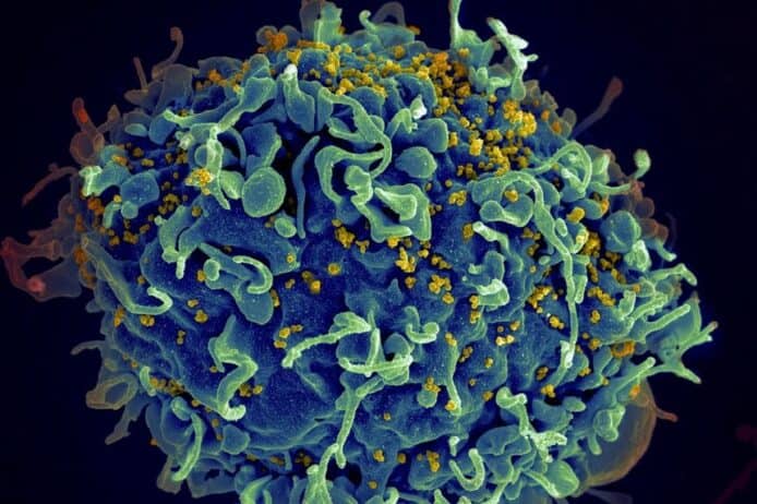 幹細胞移植治療白血病   女生意外治癒愛滋病成全球首例