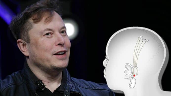 Elon Musk大腦晶片人體試驗  有望為患者恢復身體機能