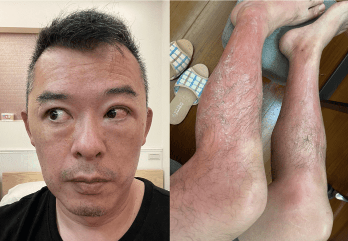 台灣車手被紫外線消毒燈嚴重燙傷　 眼角膜受損+雙腳燒傷