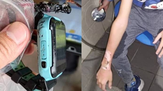 兒童智能手錶突然爆炸   台灣 10 歲男童手部燙傷或需植皮